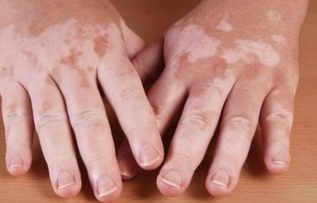 Rüyada Abraş Görmek