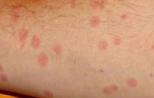 Rüyada Benek Görmek