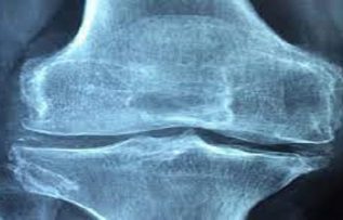 Rüyada Romatizma Görmek