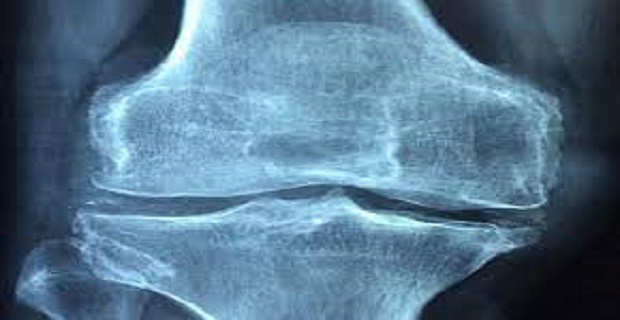 Rüyada Romatizma Görmek