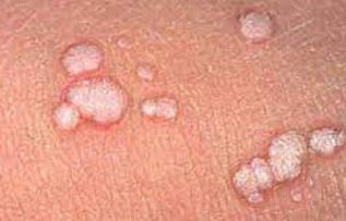 Rüyada Siğil Görmek