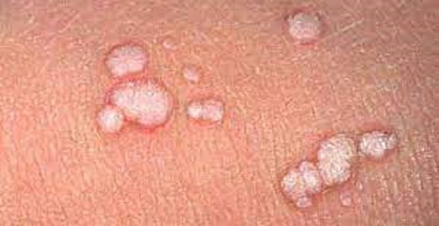 Rüyada Siğil Görmek