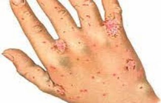 Rüyada Uyuz Görmek