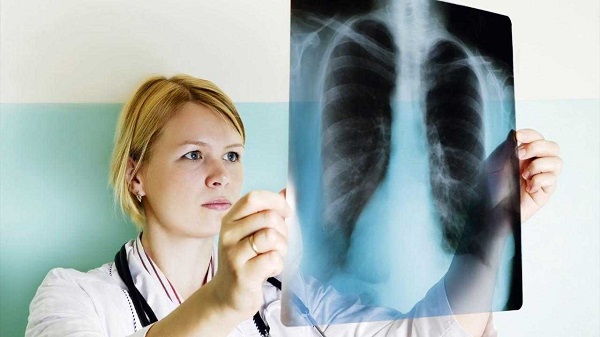 Akciğer grafisi ve tomografisi tanı için önemli
