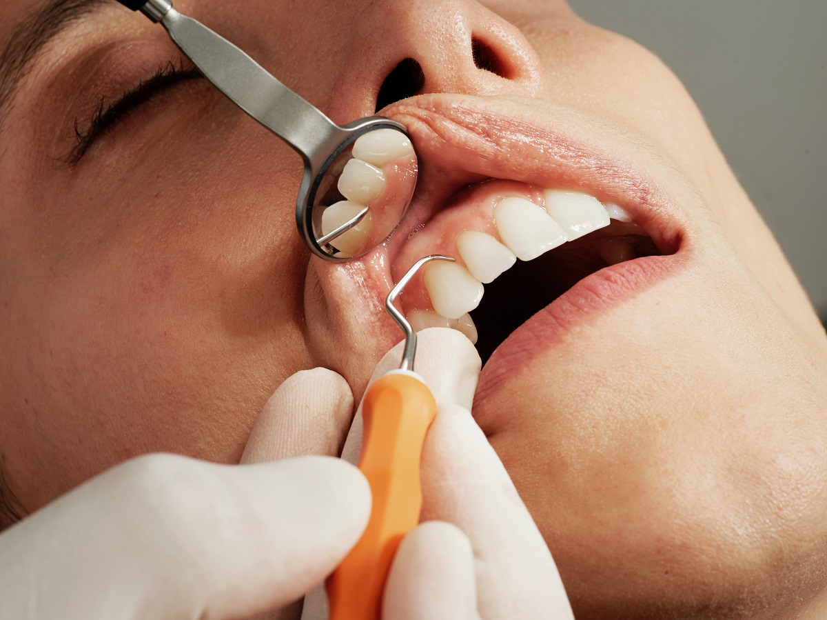 Diş eti çekilmesi önlem alınmadığında diş kaybına neden olabilir!  