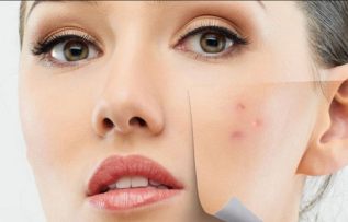 Geçmek bilmeyen sivilcelere dikkat!