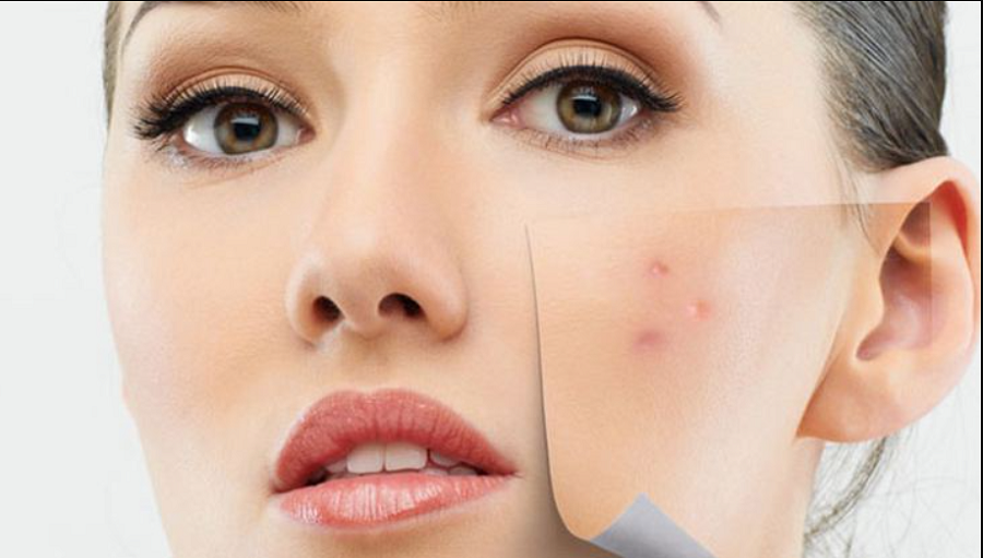 Geçmek bilmeyen sivilcelere dikkat!